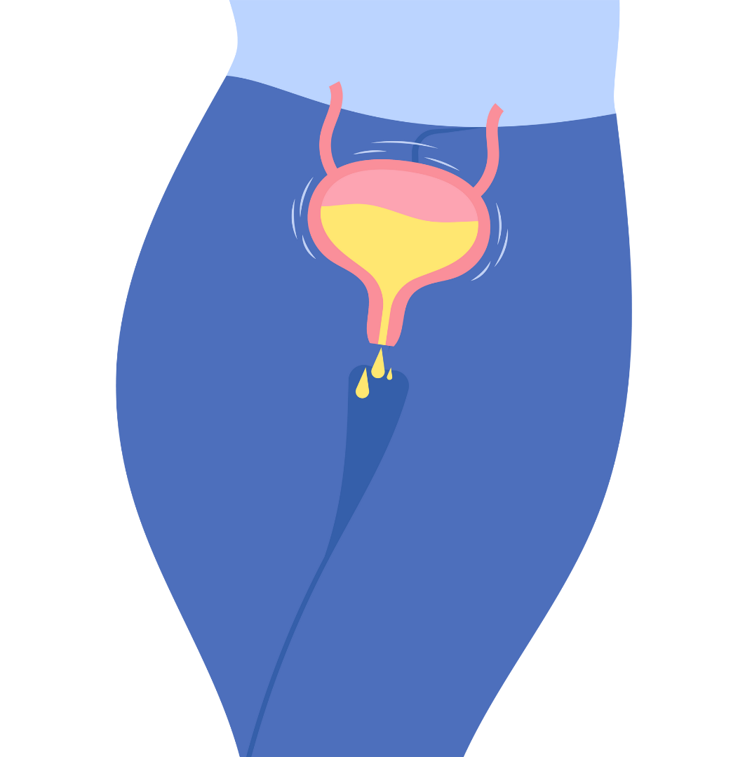 Vector image of a woman with stress urinary incontinence